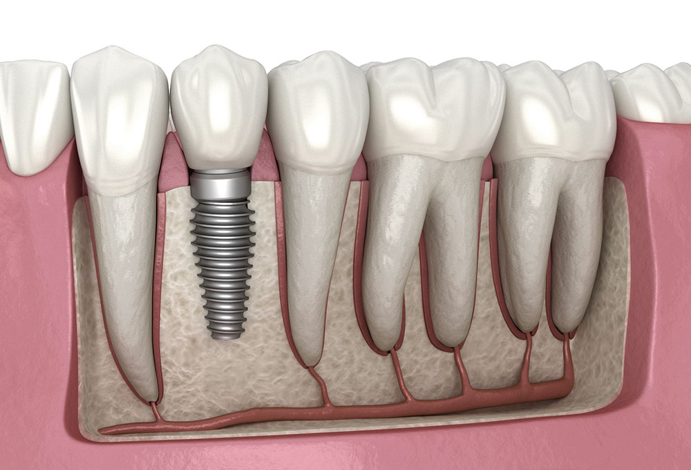Psychological impact of dental implants